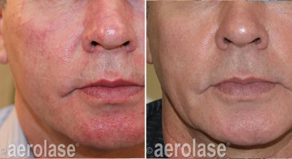Before and after skin treatment showing reduced redness and improved skin texture.