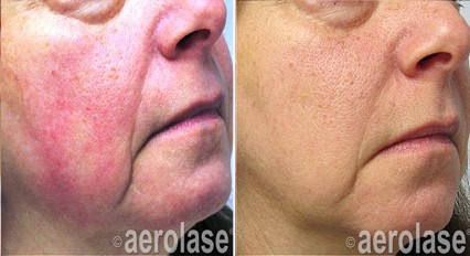 Before and after skin treatment showing reduced redness and improved skin texture.