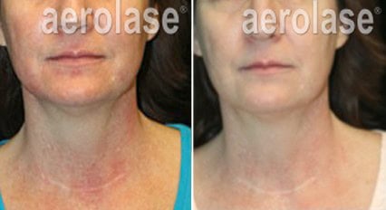 Before and after skin treatment showing reduced redness and improved skin texture.