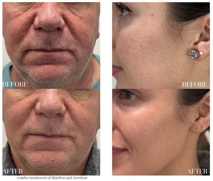 Before and after microneedling treatment showing skin improvement.