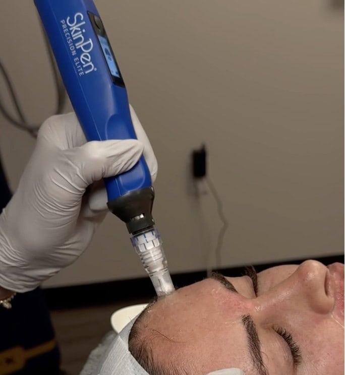 Microneedling treatment with SkinPen device on a woman's face.