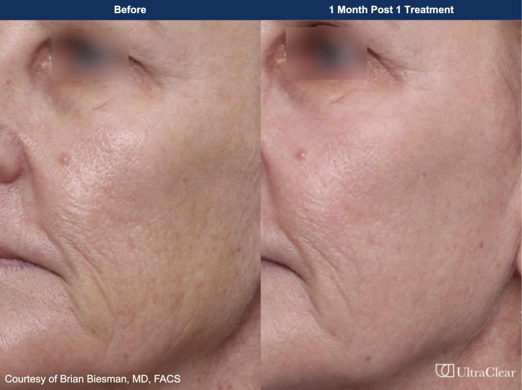 Before and after skin renewal treatment showing improved skin texture.