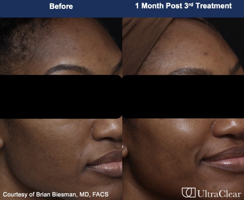 Skin improvement after UltraClear treatment for acne scars and hyperpigmentation.