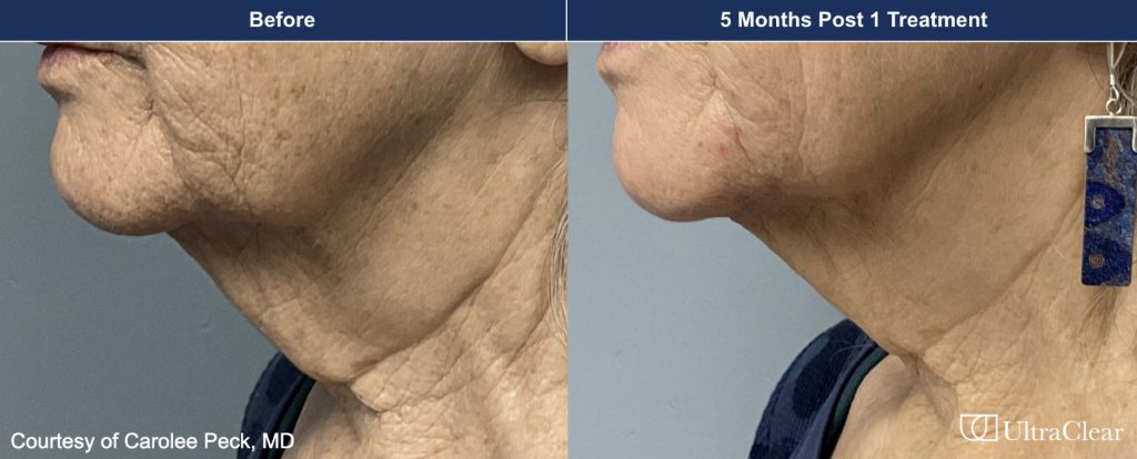 Skin tightening results after 5 months of treatment at Aesthetic RX.