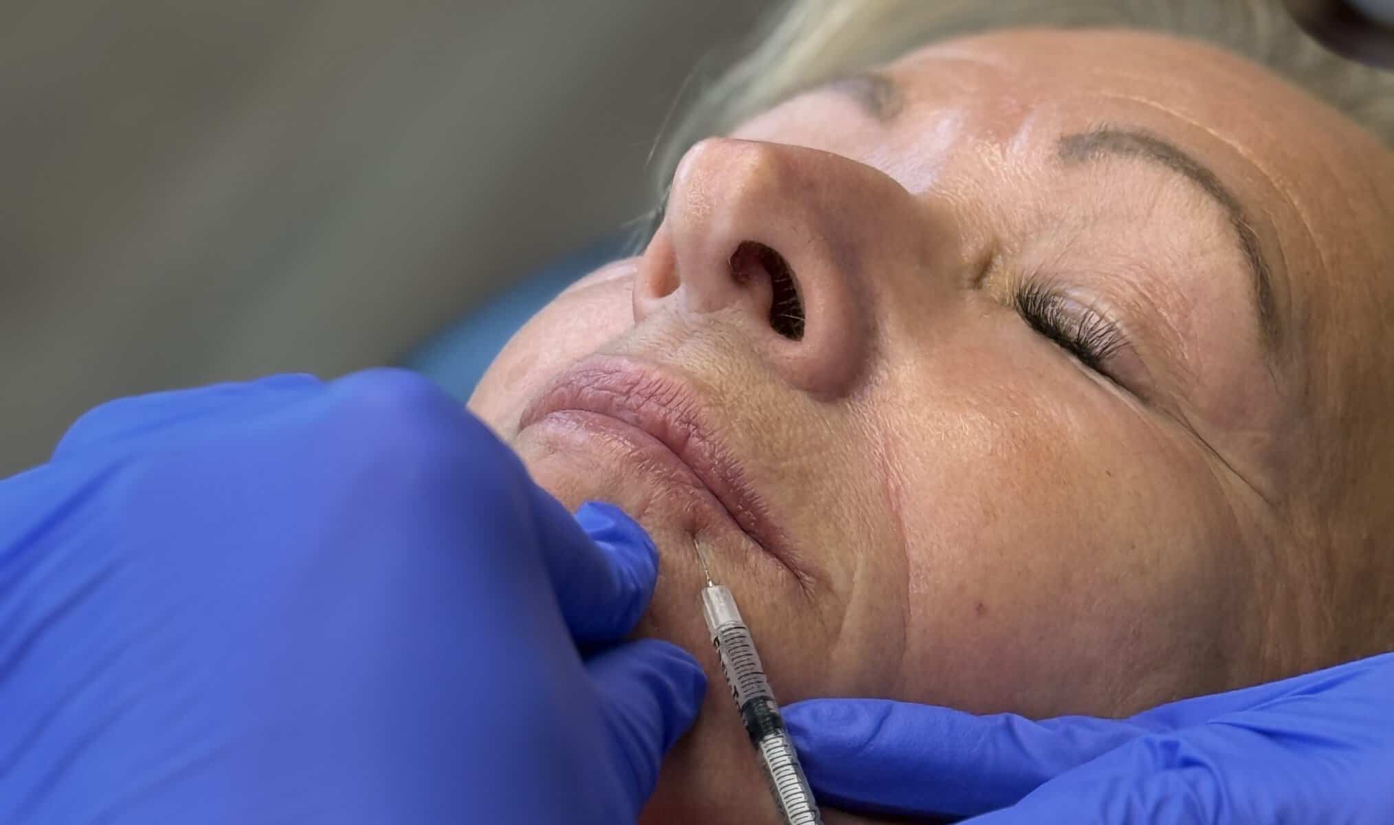 Read more about the article What Is a Lip Flip? and Is It Better Than Lip Filler for You?