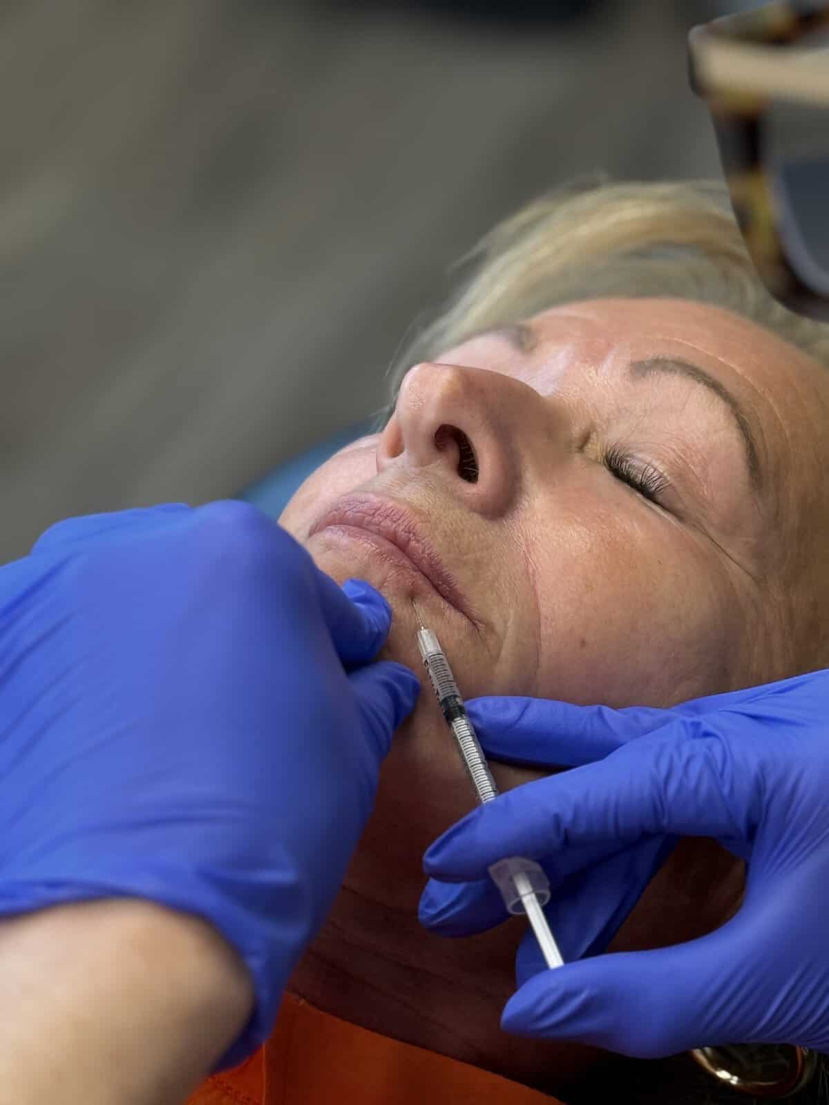 Woman receiving a lip flip procedure with a syringe and medical gloves.