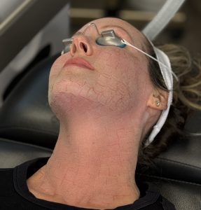 Read more about the article UltraClear Laser vs Traditional Laser Resurfacing: What Is the Difference?