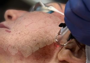 Read more about the article How Does UltraClear Laser Work? What Novi Patients Should Know
